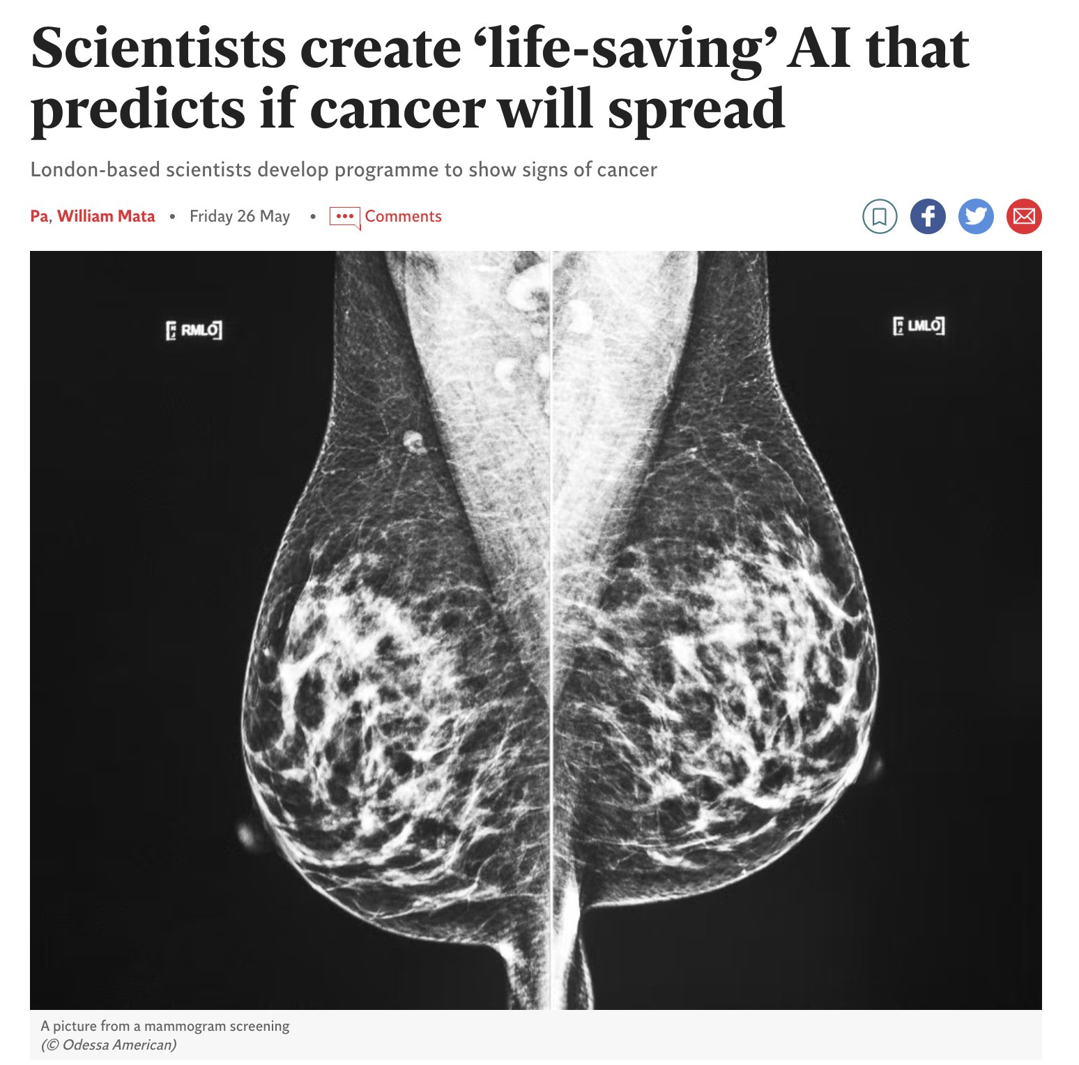 AI Predicts Breast Cancer Spread for Personalized Treatment