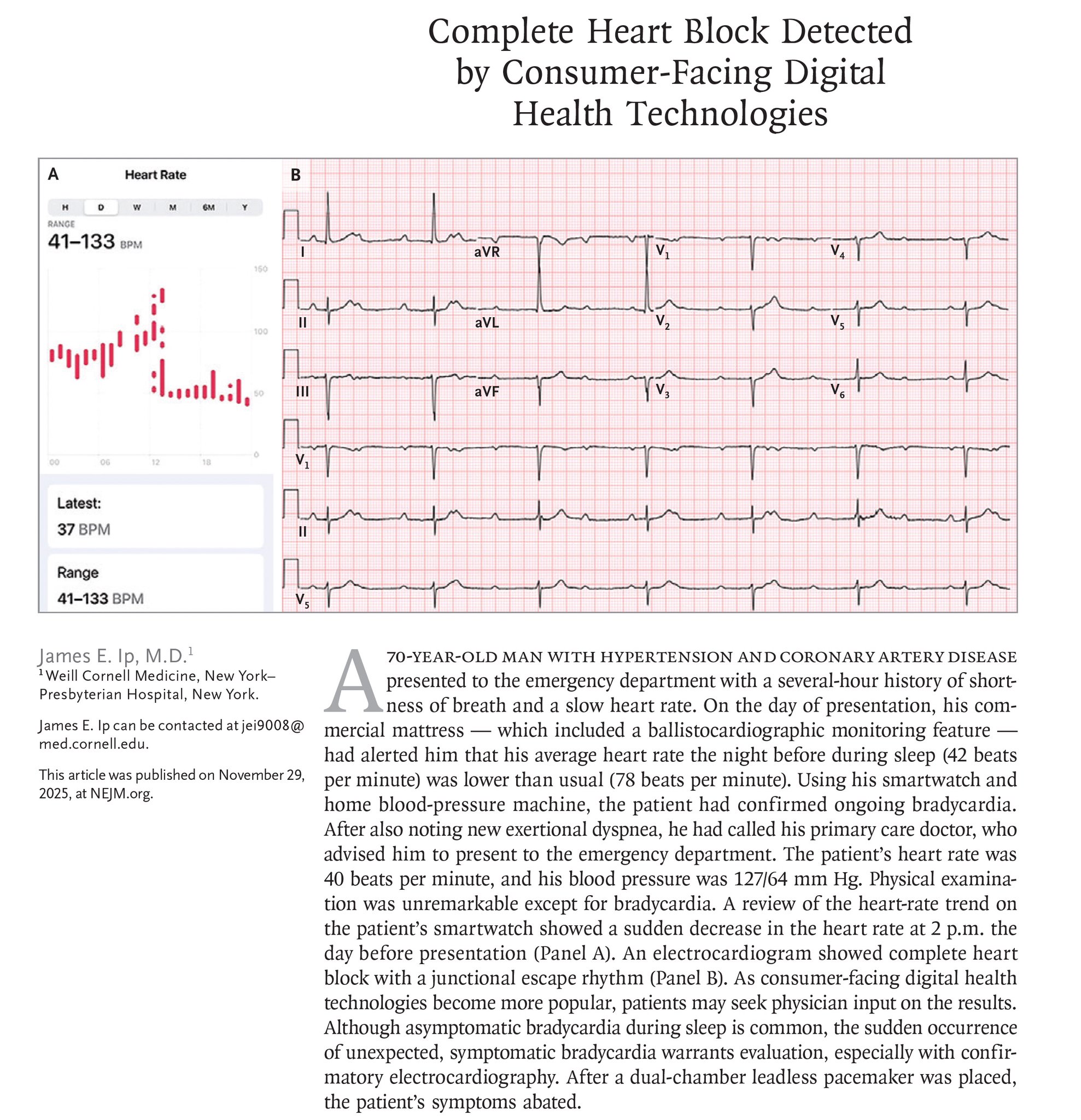 Smartwatch and mattress sensor diagnose complete heart block