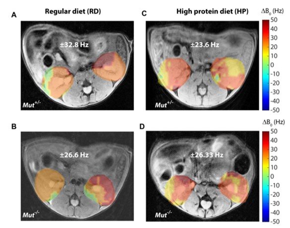 AI Transforms Kidney Disease Diagnosis and Management