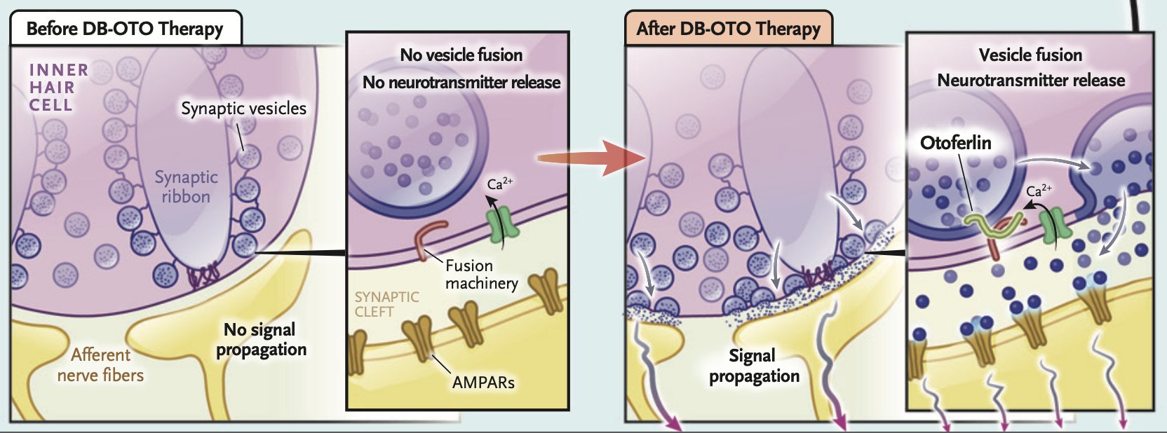 Gene therapy restores hearing in deaf children via one-shot treatment