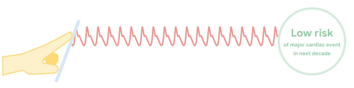 Deep Learning PPG Smartphones Predict Cardiovascular Disease Early