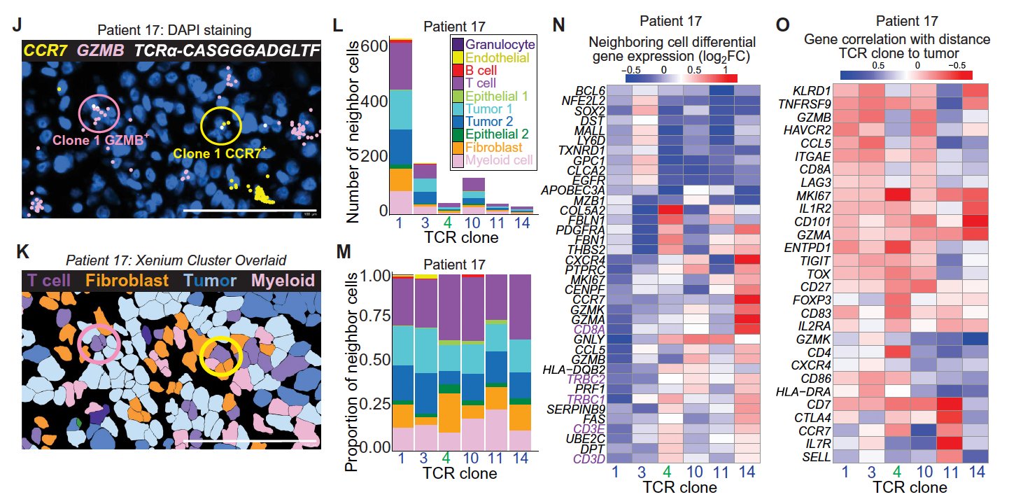 Spatial Biology and AI Advancing Personalized Cancer Immunotherapy