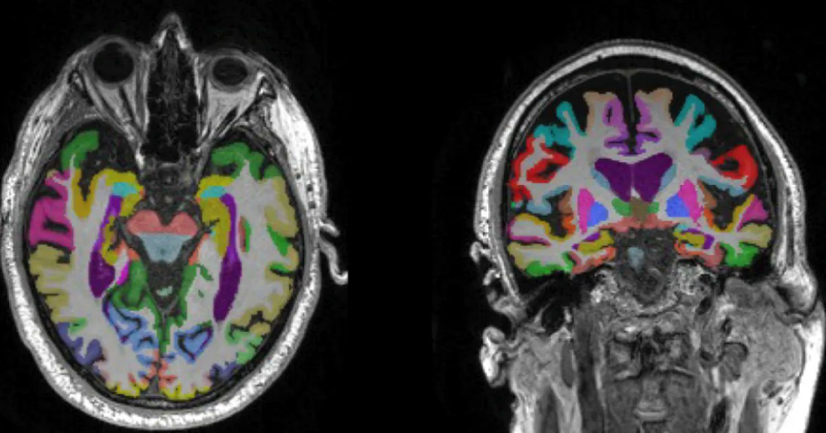 AI-Enabled App Analyzes MRI Data for Dementia Evaluation