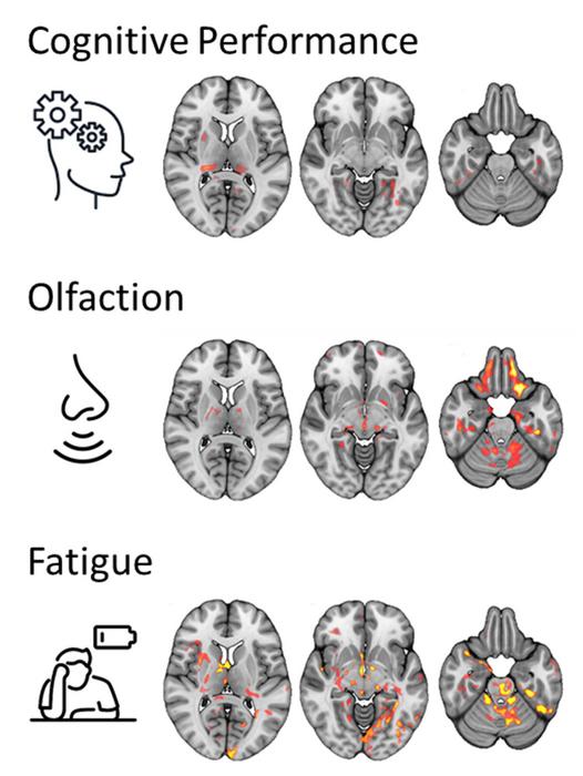 Brain MRI with AI detects Long Covid microstructure changes