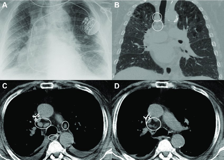 AI Identifies Five New Heart Failure Categories from 300K Records
