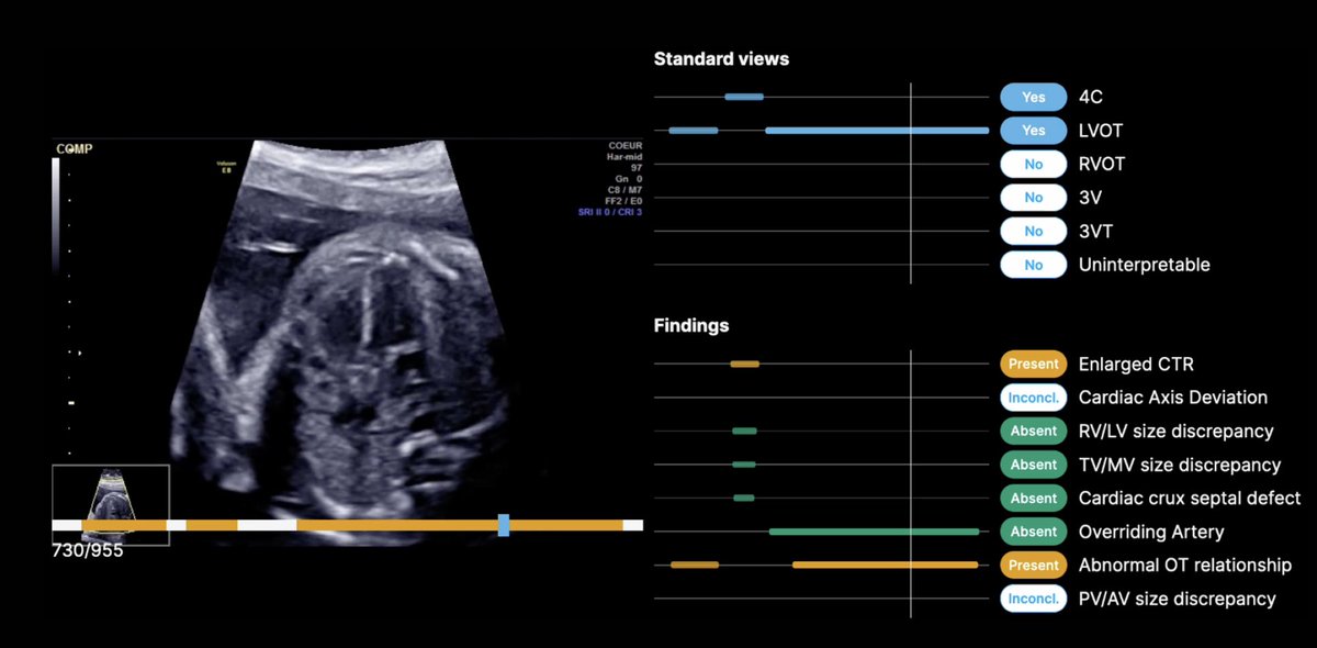 DINOv2 Detects Congenital Heart Defects in Children Faster