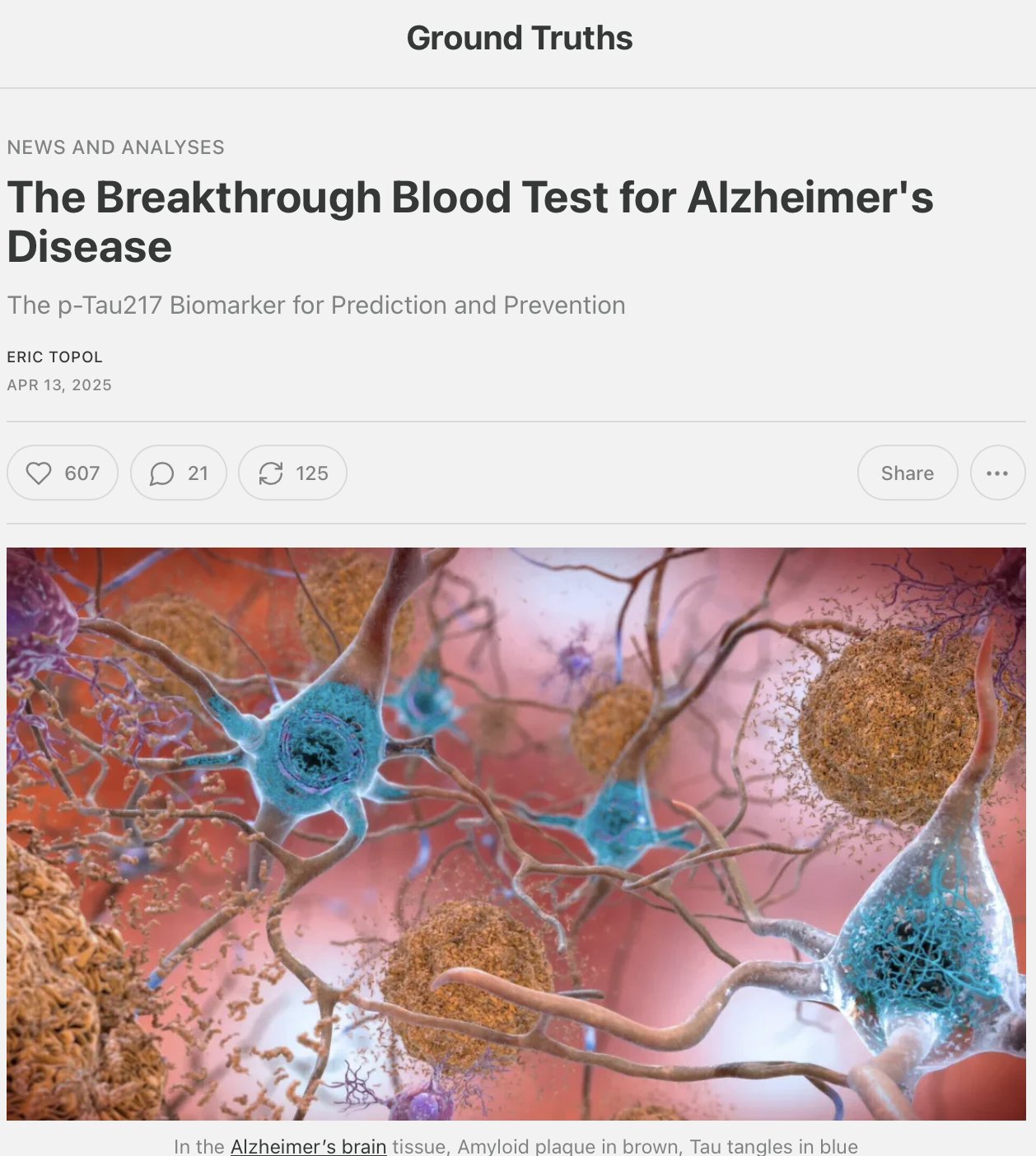 Breakthrough Blood Test for Alzheimer’s Disease Prediction