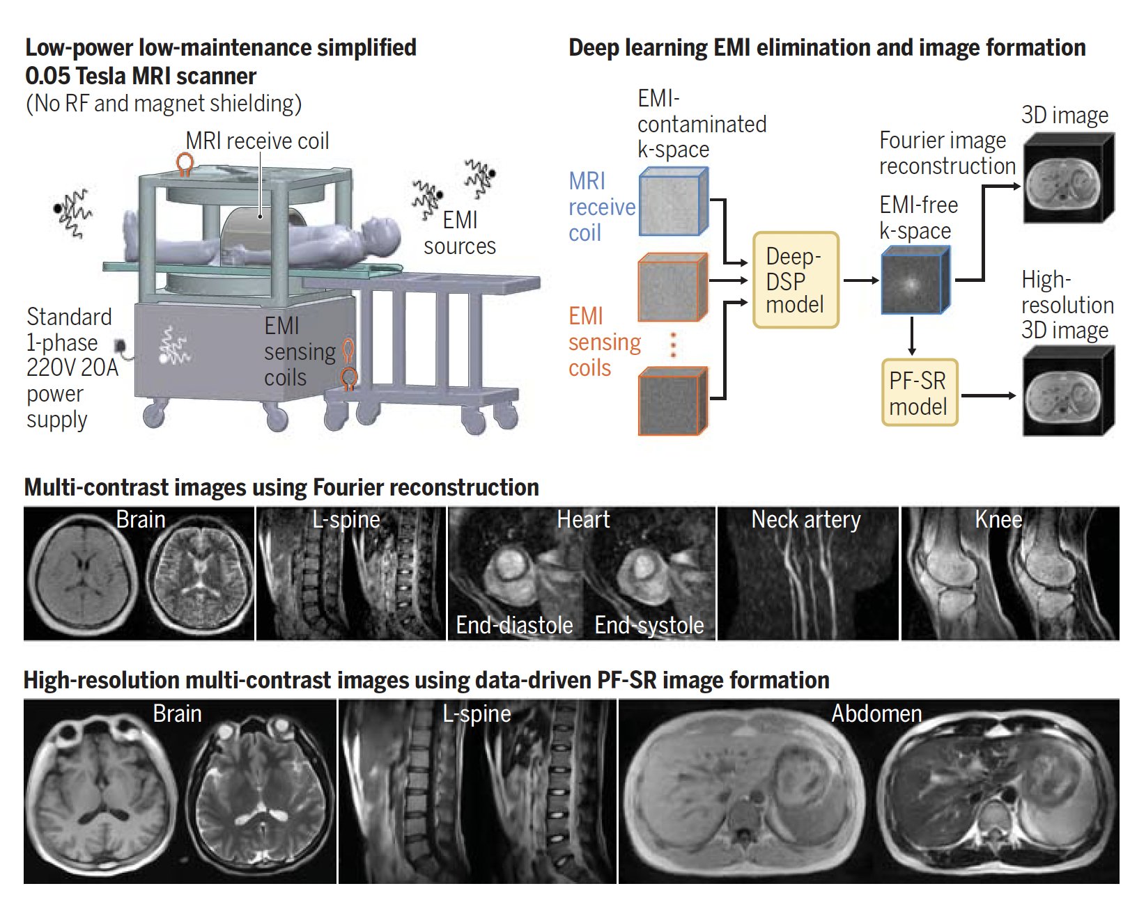 Low-field MRI with deep learning transforms affordable point-of-care imaging