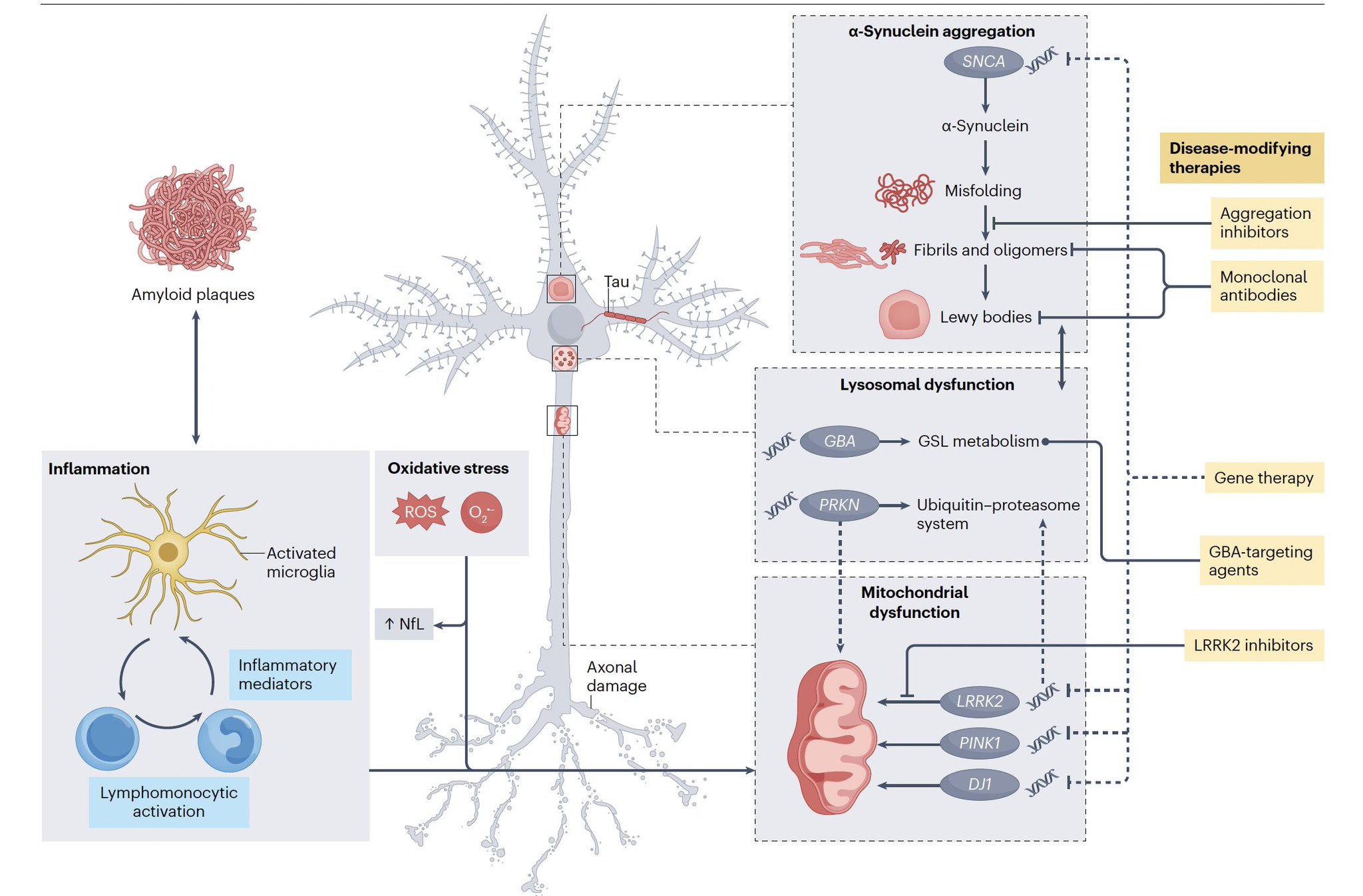 AI Needed for Parkinson’s Disease Treatment Breakthrough