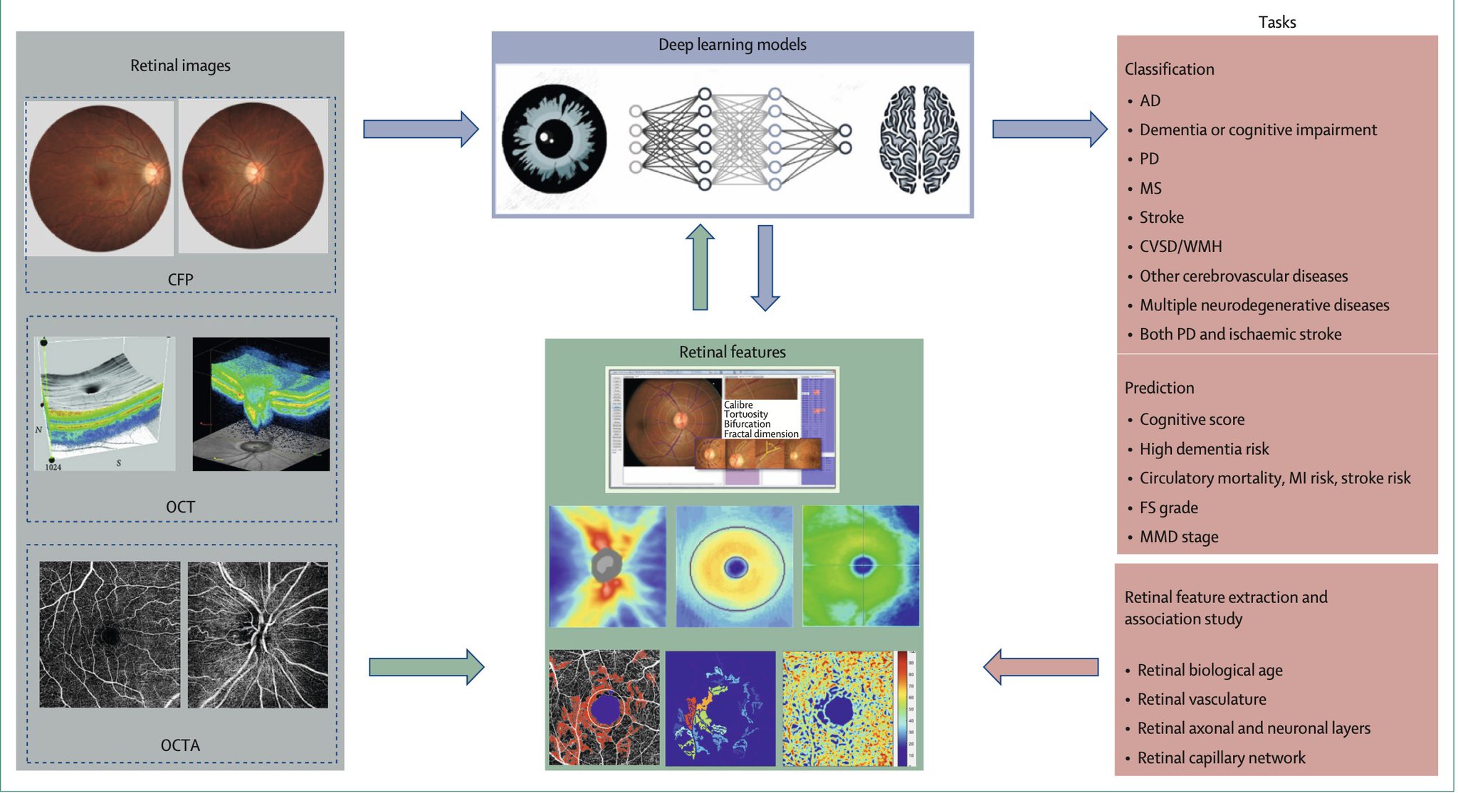 AI-analyzed retina photo reveals brain health